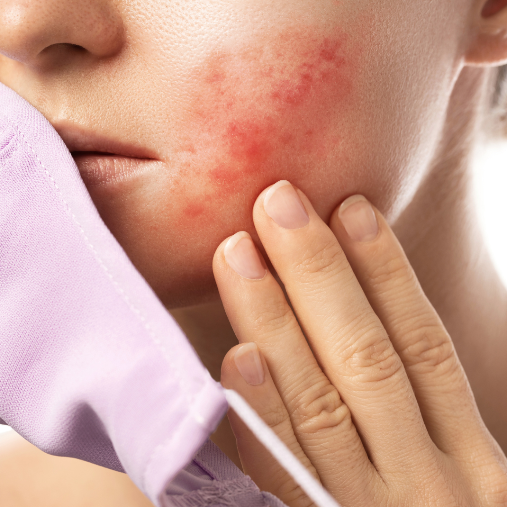 eczema, rosacea, dermatitis, perioral dermatitis, sensitive skin, delicate skin